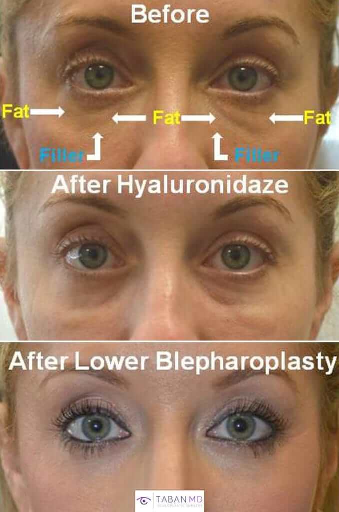 37 year old female, with history of unsuccessful under eye filler (to camouflage under eye fat bags) underwent initial hyaluronidaze to dissolve the filler followed later by transconjunctival lower blepharoplasty with fat bags repositioning and skin pinch. Before and 3 months after eyelid surgery photos are shown.