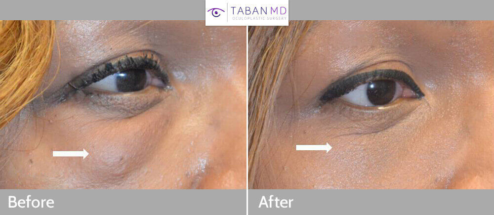 Middle age African American female, with history of eyelid fat injection (by another surgeon) causing significant lumps, underwent scarless technique (from inside the lower eyelid) to remove fat lumps or granulomas. Before and 1 month after revision eyelid surgery photos are shown.