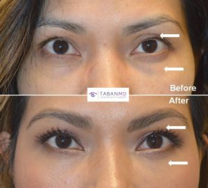 Young Asian lady, complained of upper eyelid asymmetry, droopy lazy left eye, and under eye bags. She underwent left upper eyelid ptosis surgery, bilateral upper eyelid Asian blepharoplasty and lower blepharoplasty (transconjunctival with fat repositioning). Before and 2 months after eyelid surgery photos are shown.