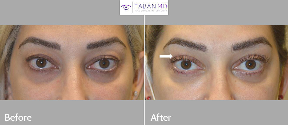 Young woman, with loose upper eyelid skin and hollowness, underwent combined upper blepharoplasty and upper eyelid filler injection, resulting in more youthful eye appearance.