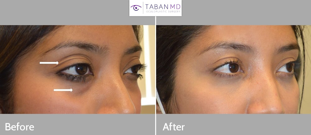 Young mother, with upper eyelid aging (loose saggy skin and fat loss), underwent combined upper blepharoplasty and upper eyelid filler injection. Note improved rested eye appearance after mommy makeover.