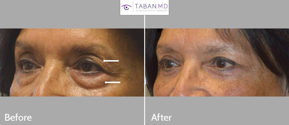 78 year old woman, with eyelid aging, underwent upper blepharoplasty (eyelid lift) and lower blepharoplasty. Note more rested youthful eye appearance with natural results. (She has uncorrected asymmetric brow ptosis.)