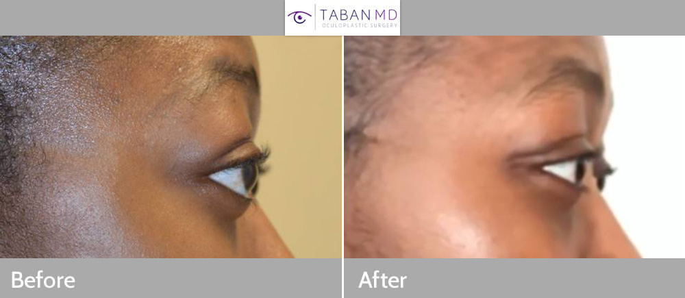 Young beautiful African American woman, with genetic bulging eyes, underwent scarless orbital decompression surgery plus lacrimal gland repositioning.