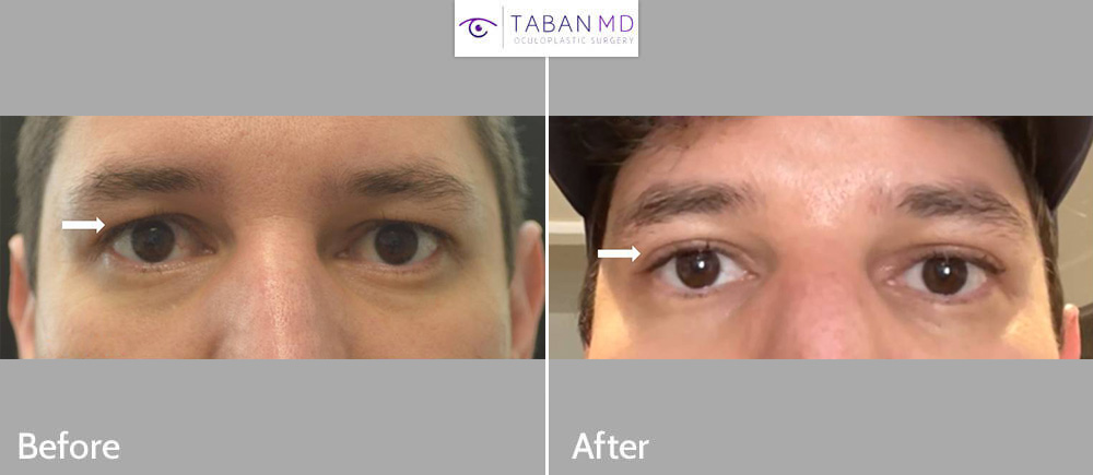 Young man, with hooded tired upper eyelids, underwent male upper blepharoplasty with natural results.