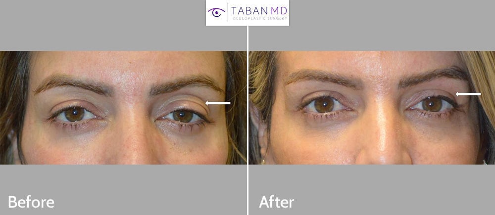 41 year old female, with tired eye appearance and eye asymmetry, underwent droopy upper eyelid ptosis surgery, upper blepharoplasty, and upper lid filler injection. Note more youthful eye appearance.