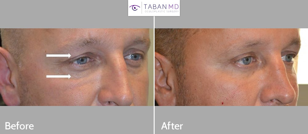 Gentleman, with tired appearing eyes, underwent male upper blepharoplasty and lower blepharoplasty.