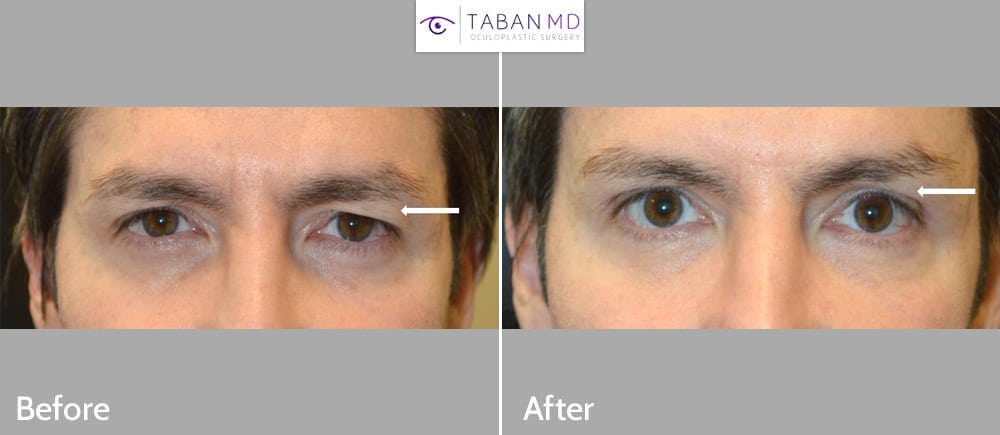 Middle age man, an ER physician with upper eyelid hooding and low brows, underwent male upper blepharoplasty.