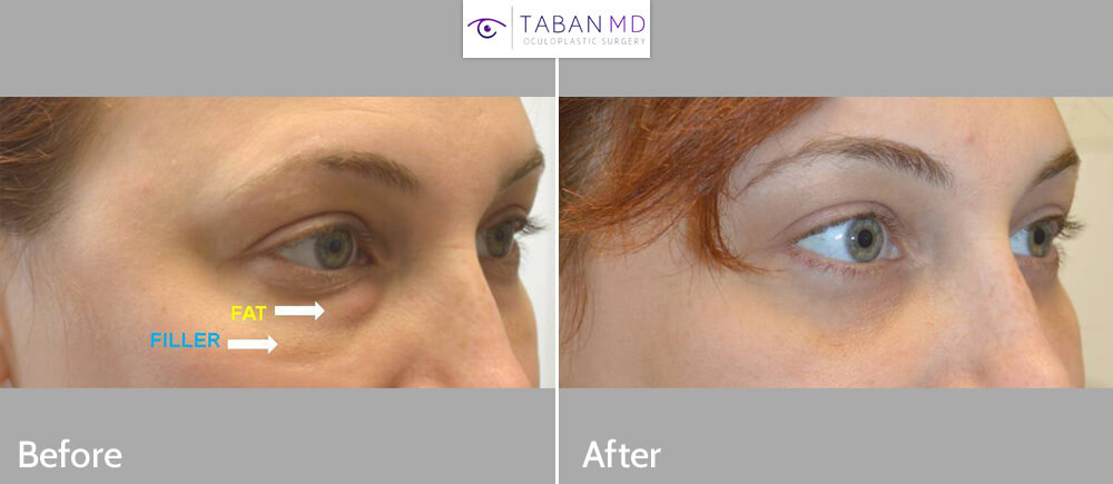 32 year old female, with previous indequate under eye filler injection to tear trough area, underwent first hyaluronidase to remove the filler and then lower blepharoplasty (transconjunctival with fat repositioning with skin pinch). Note youthful natural results with much more improved under eye appearance.