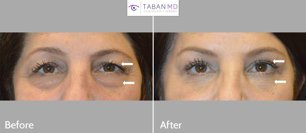 58 year old female, complained of eyelid aging with saggy upper eyelids and under eye bags and hollowness. She underwent upper blepharoplasty and lower blepharoplasty (transconjunctival technique with eye fat repositioning and skin pinch).