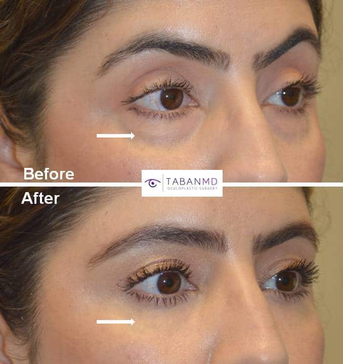 42 year old female, with eyelid aging, underwent upper blepharoplasty, lower blepharoplasty, droopy upper eyelid ptosis surgery, and upper eyelid filler injection. Note more youthful rested eye appearance.