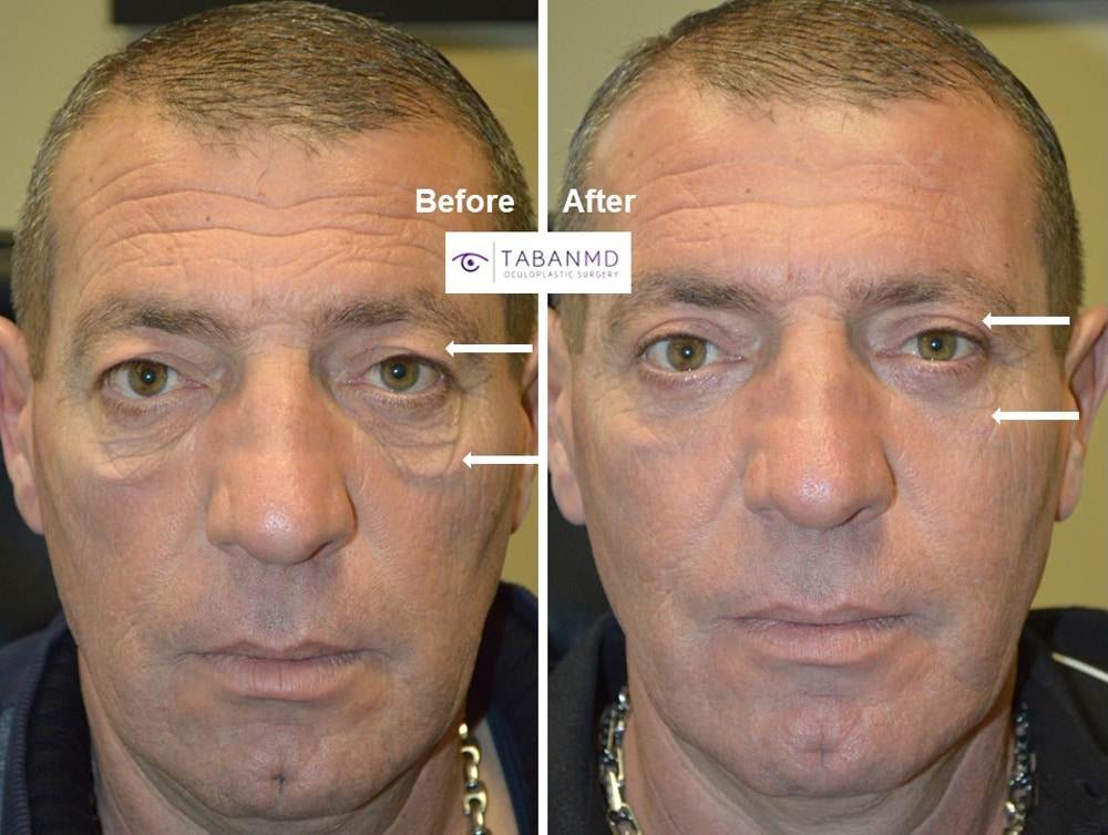 Middle age man underwent male upper blepharoplasty and lower blepharoplasty and festoon excision.