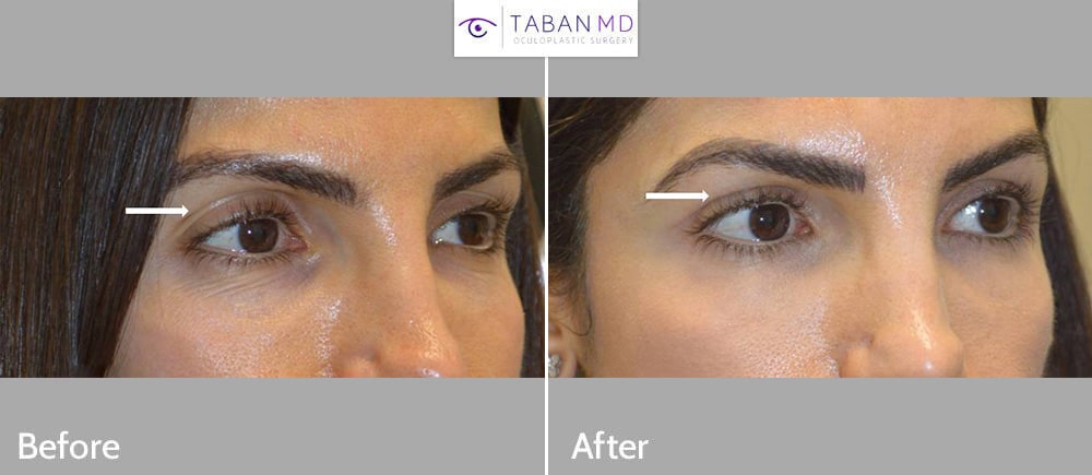 Young woman, with sunken upper eyelids and loose skin folds and eye asymmetry, underwent combined upper blepharoplasty (eyelid lift) and upper eyelid filler injection.