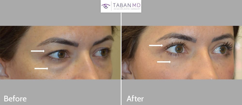 41 year old female, underwent upper blepharoplasty (eyelid lift) and scarless lower blepharoplasty. Note natural refreshed results after eyelid surgery.