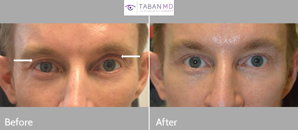 Young man with genetic and age-related complex upper eyelid/brow asymmetry underwent Right upper blepharoplasty plus Left upper eyelid filler injection. Note more symmetric and youthful natural eye appearance.
