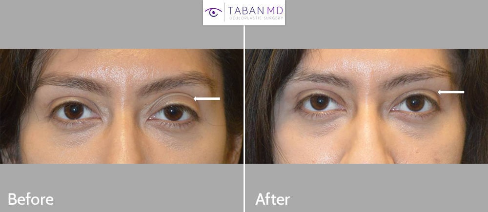 Young woman with genetic complex upper eyelid (eye) asymmetry underwent Left upper eyelid ptosis surgery, Left upper blepharoplasty, and Left upper eyelid filler injection. Note more symmetric and youthful natural eye appearance.