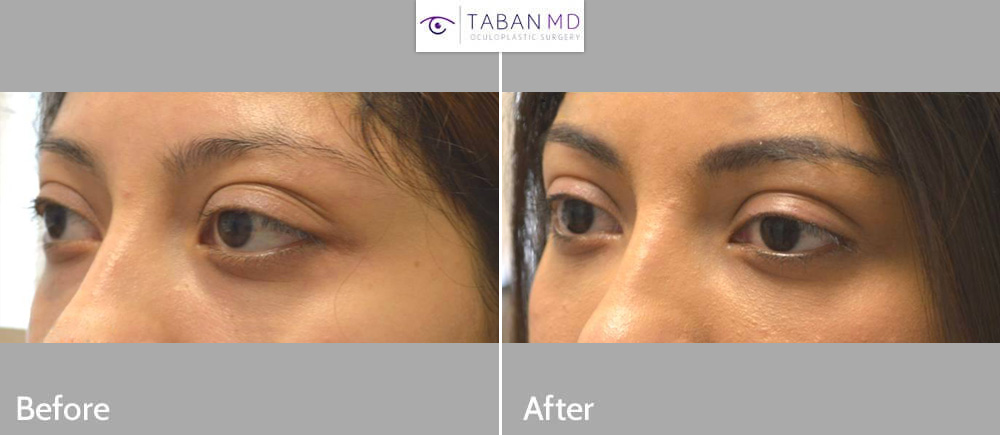 Young beautiful woman with genetic prominent bulging eyes underwent scarless cosmetic orbital decompression surgery.