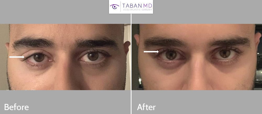 Young man, with history of failed right upper eyelid ptosis surgery (by another surgeon), underwent complex revision eyelid ptosis repair. Note the significant improvement in his before and after selfie photos.