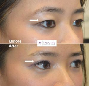 Young Asian woman underwent Asian upper blepharoplasty to have more defined upper eyelid crease. Before and 3 months after Asian eyelid surgery photos are shown.