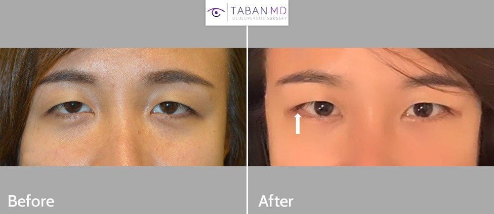 Young woman underwent lateral canthoplasty to create more upturned or positive canthal tilt or cat eye appearance.