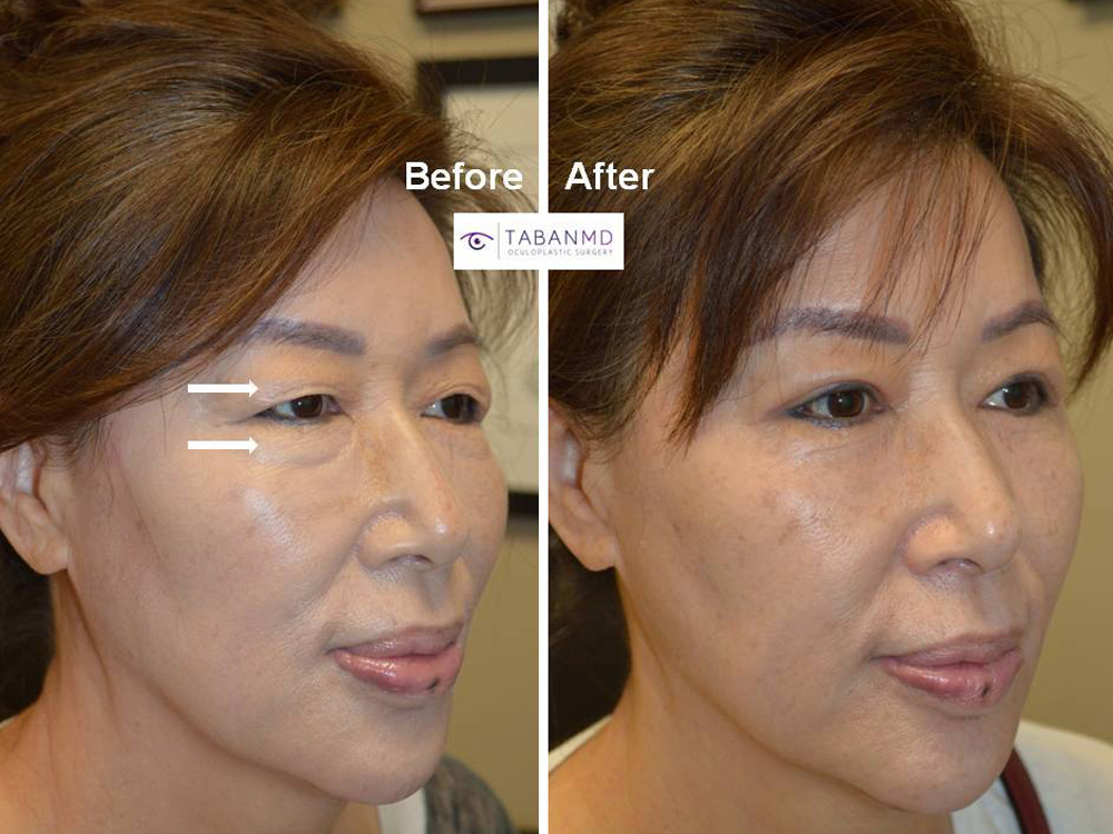 65 year old Asian female, underwent Asian upper blepharoplasty (double eyelid surgery) and lower blepharoplasty, resulting in more youthful, rested, natural eye appearance.