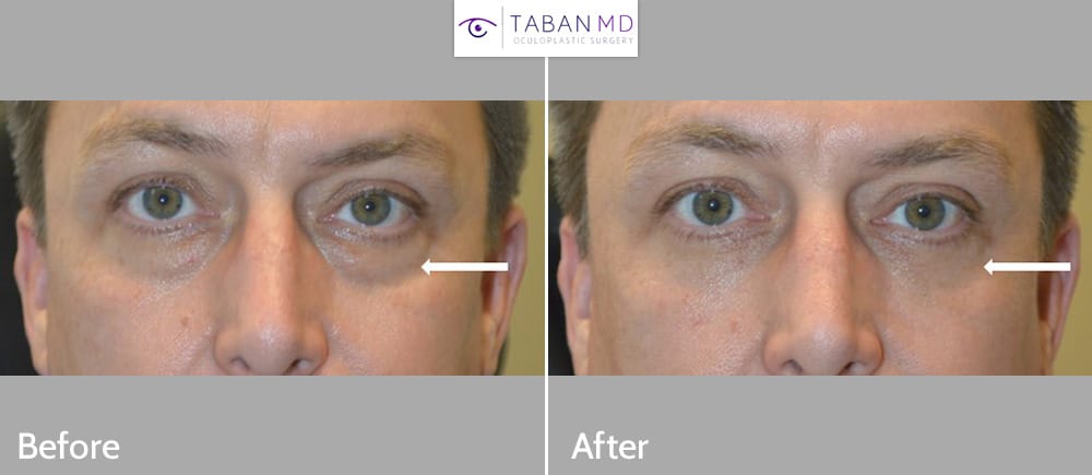 Gentleman, with under eye bags, underwent lower blepharoplasty. Note natural results with rested eye appearance.