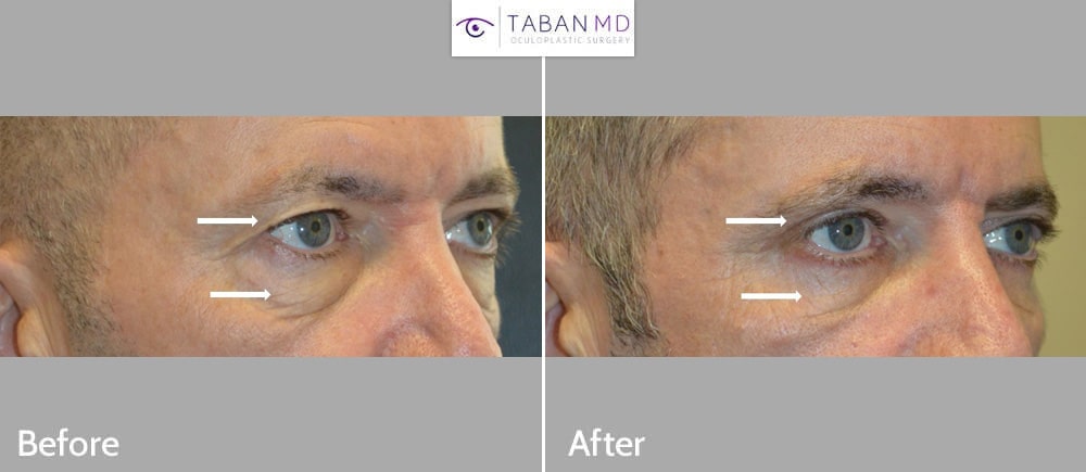 Middle age man, underwent male upper blepharoplasty and lower blepharoplasty. Before and 3 months after cosmetic eyelid surgery photos are shown. (His festoons remained.)