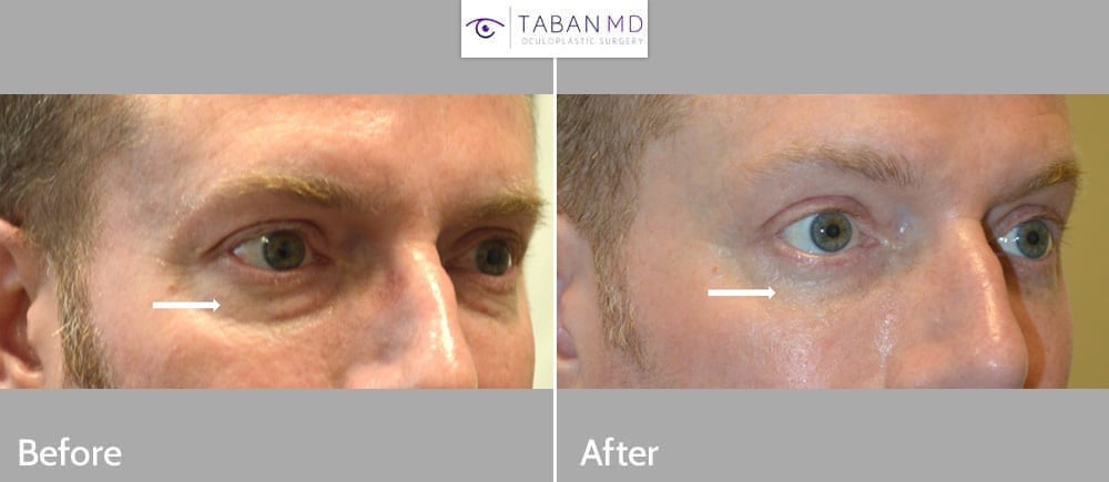Middle age man who underwent lower blepharoplasty (transconjunctival technique with eye fat bags repositioning and skin pinch).