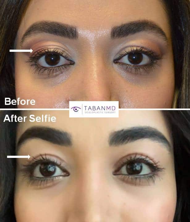 Young woman underwent upper blepharoplasty (to correct loose saggy upper eyelid skin folds) and lacrimal gland repositioning (to correct lacrimal gland prolapse) and upper eyelid filler injection (to correct upper eyelid hollowness). Her before and selfie after photos are shown.