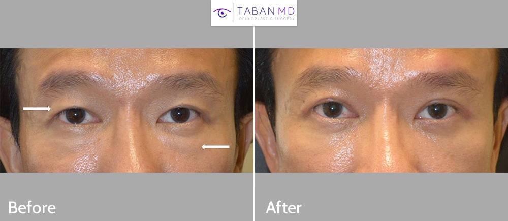 49 year old Asian male, with history of prior upper blepharoplasty, underwent revision Asian upper blepharoplasty (double eyelid surgery) and scarless lower blepharoplasty. Note more youthful natural results.