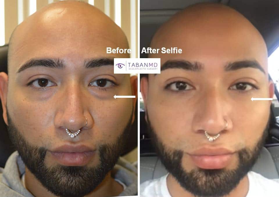 Young man, with tired eyes due to under eye fat bags and dark circles, underwent scarless transconjunctival lower blepharoplasty (with eye fat bags repositioning to tear trough area). His before and after selfie photos are shown.