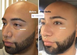 Young man, with tired eyes due to under eye fat bags and dark circles, underwent scarless transconjunctival lower blepharoplasty (with eye fat bags repositioning to tear trough area). His before and after selfie photos are shown.