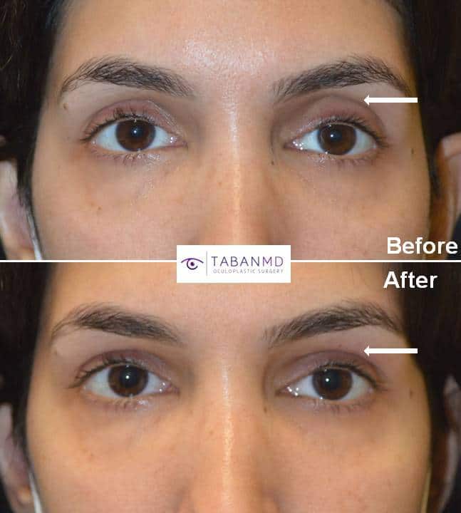 Beautiful woman with rounded eye appearance due to upper eyelid fat loss (hollowness) underwent upper eyelid filler injection. Before and immediately after injection photos are shown. Note more almond shaped and youthful eye appearance.