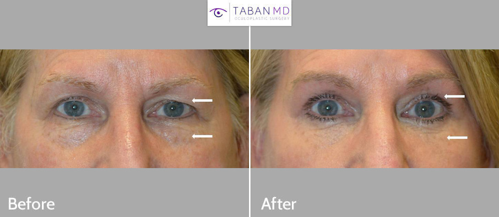 60+ year old woman, underwent quad-blepharoplasty (upper blepharoplasty and lower blepharoplasty). Note more rested, youthful eye appearance.