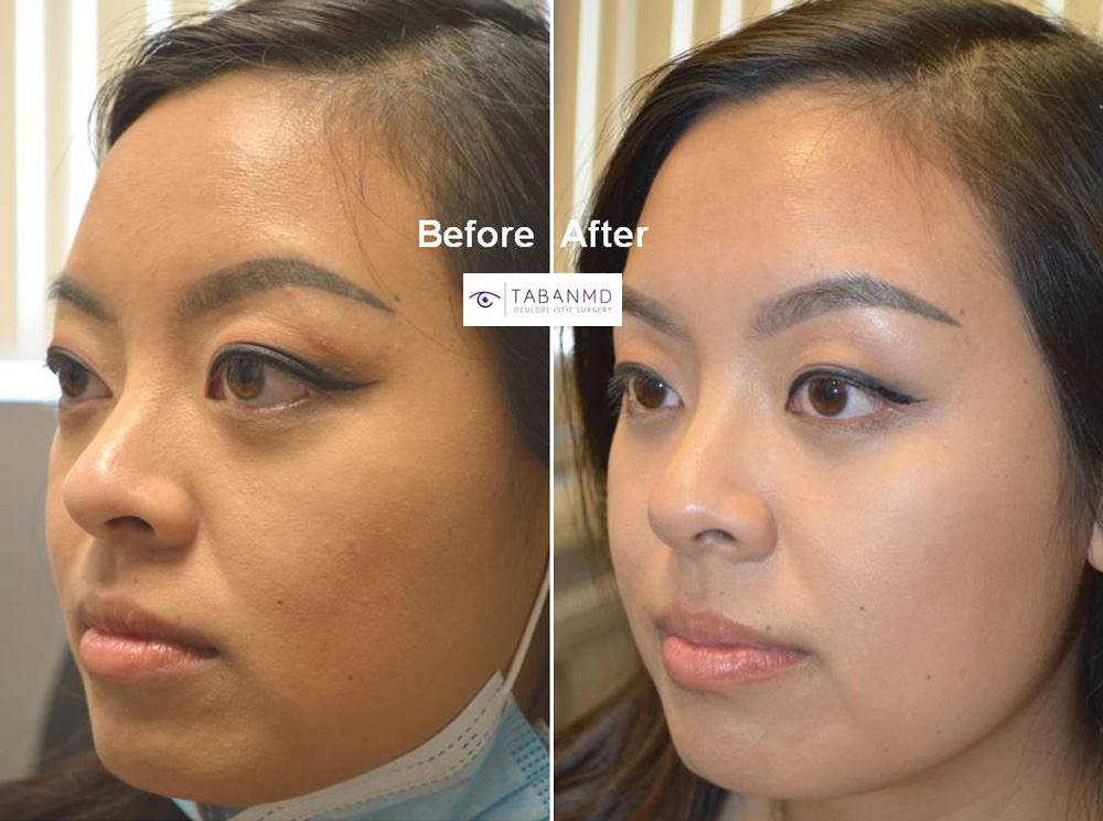 Young beautiful Asian female, with congenital protruding eyeballs, underwent scarless orbital decompression surgery with quick healing. Her before and 1 month after bulging eye surgery photos are shown.