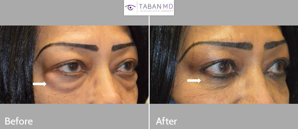 73 year old African American woman with huge under eye fat bags underwent scarless transconjunctival lower blepharoplasty. (She declined skin removal.)