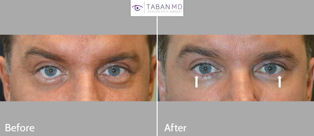 Lower eyelid retraction repair in a man who suffered from lower eyelid retraction after botched lower blepharoplasty. Note improvement in eye shape, going from rounded eyes to more almond shaped eyes.