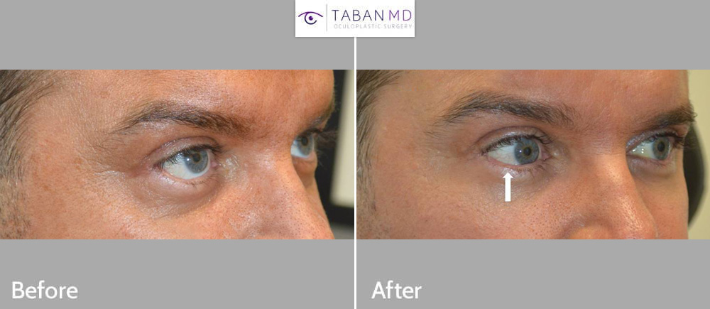 Lower eyelid retraction repair in a man who suffered from lower eyelid retraction after botched lower blepharoplasty. Note improvement in eye shape, going from rounded eyes to more almond shaped eyes.