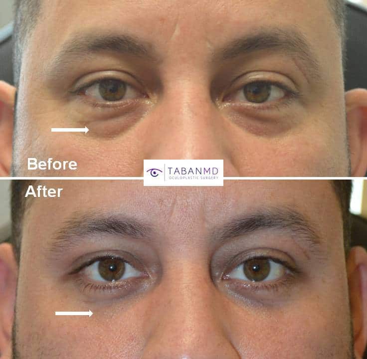 Young man, who complained of under eye bags and dark circles making him look tired, underwent scarless transconjunctival lower blepharoplasty with quick healing.