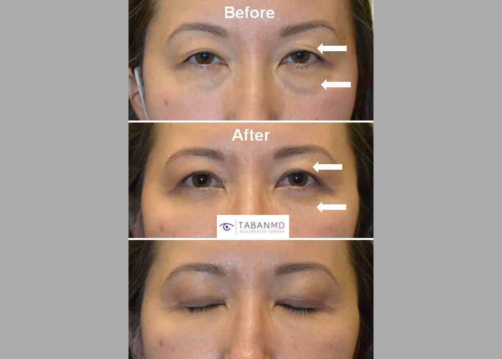 46 year old Asian female, underwent conservative Asian upper blepharoplasty plus lower blepharoplasty. Note more rested eye appearance.