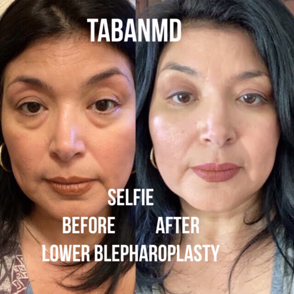 Before and after selfie photos of a woman with under eye fat bags and tear trough hollowness who underwent scarless lower blepharoplasty (transconjunctival technique with eye fat bags repositioning to surrounding hollow area after arcus marginalis release). Note more rested eyes.