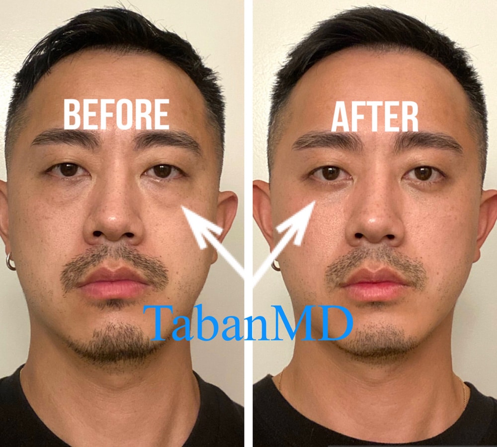 Young man, with genetic under eye bags, underwent scarless lower blepharoplasty. His before and after selfie photos are shown.