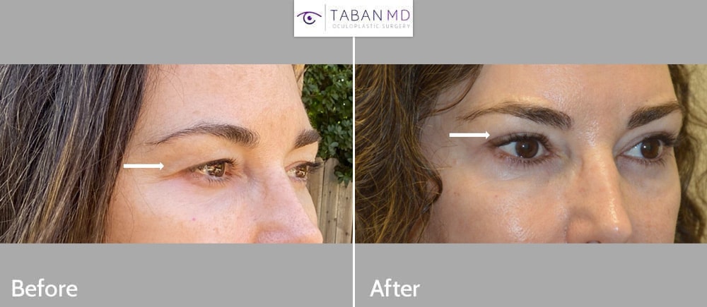 55 year old woman, with tired/older eye appearance, underwent upper blepharoplasty (eyelid lift).