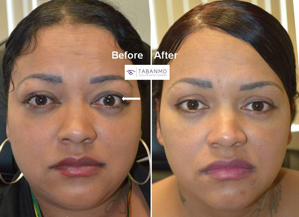 hypothyroidism before and after face