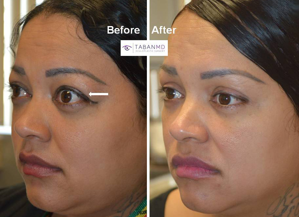 35 year old female, with Graves thyroid eye disease, causing bulging eyes and eyelid retraction and puffy eyelids, underwent combined scarless orbital decompression and blepharoplasty.