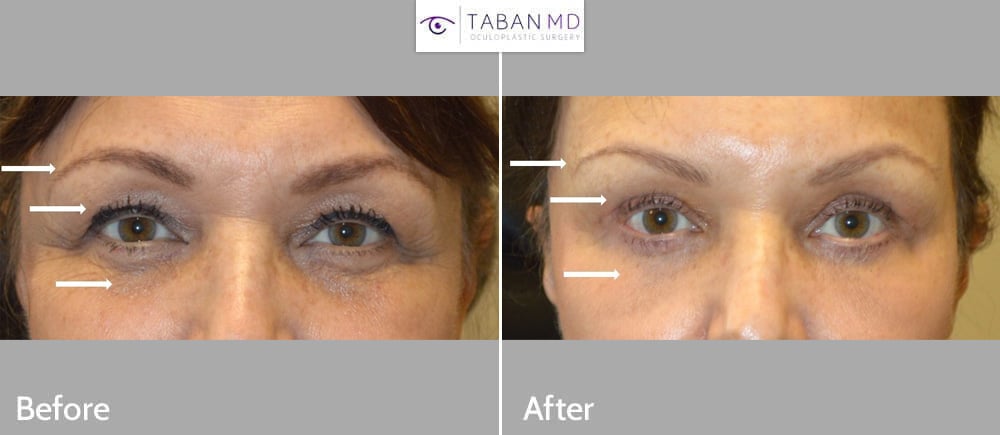 54 year old female, with eyelid aging, underwent upper blepharoplasty, lower blepharoplasty (transconjunctival approach with eye fat repositioning plus skin pinch) and lateral brow lift.