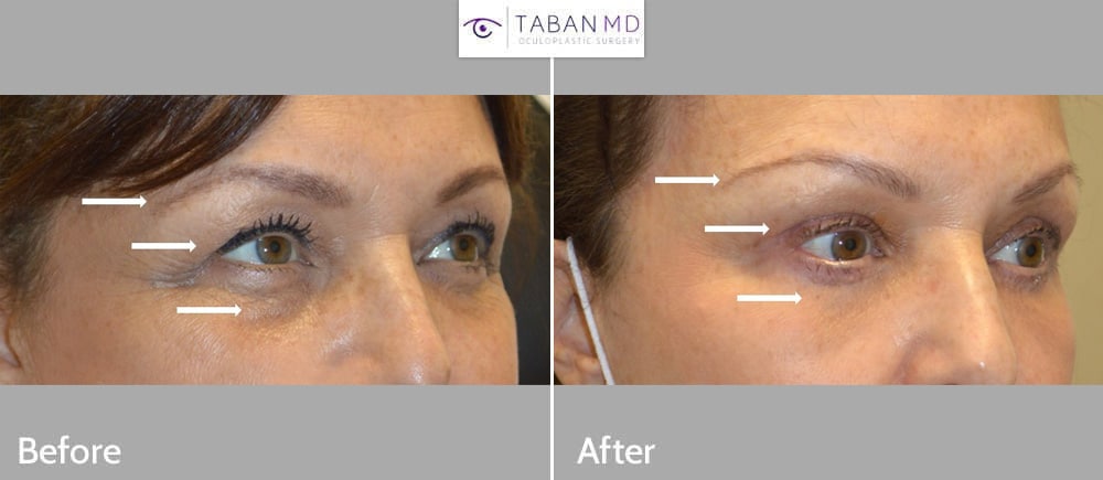 54 year old female, with eyelid aging, underwent upper blepharoplasty, lower blepharoplasty (transconjunctival approach with eye fat repositioning plus skin pinch) and lateral brow lift.
