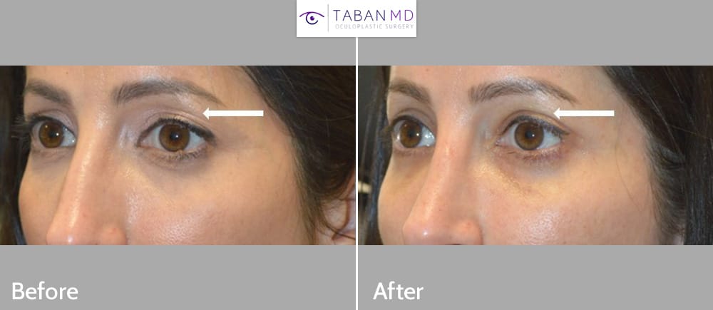 Woman, with upper eyelid aging and asymmetry, underwent customized combined upper blepharoplasty and filler injection. Note youthful and natural results.