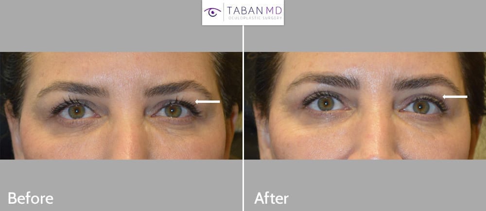 48 year old woman, with eyelid aging, underwent upper and lower blepharoplasty. Note natural refreshed results.