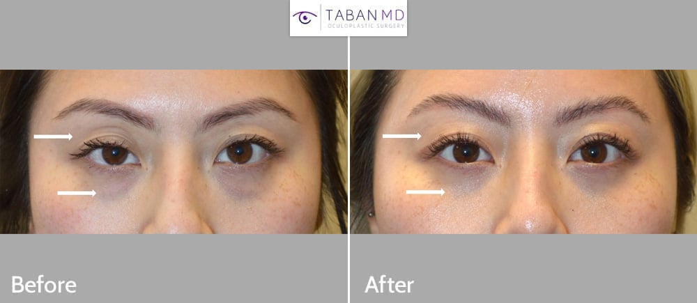 Young Asian woman underwent scarless lower blepharoplasty and Asian upper blepharoplasty and ptosis surgery. Note improved eye symmetry and youthful eye appearance.