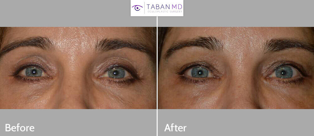 Before (left) Middle age woman with upper eyelid hollowness and sunken eyes after blepharoplasty. After (right) after upper eyelid-brow filler (Belotero) injection. Note more youthful appearance.
